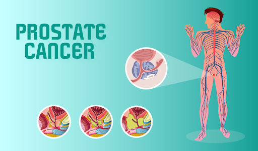 How To Avoid Prostate Cancer?